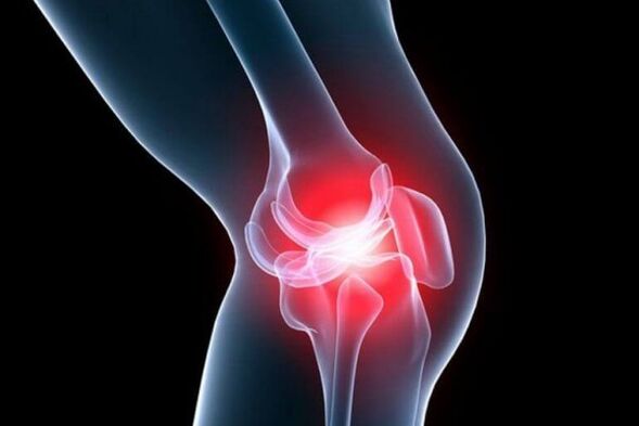 Артроз коленного сустава